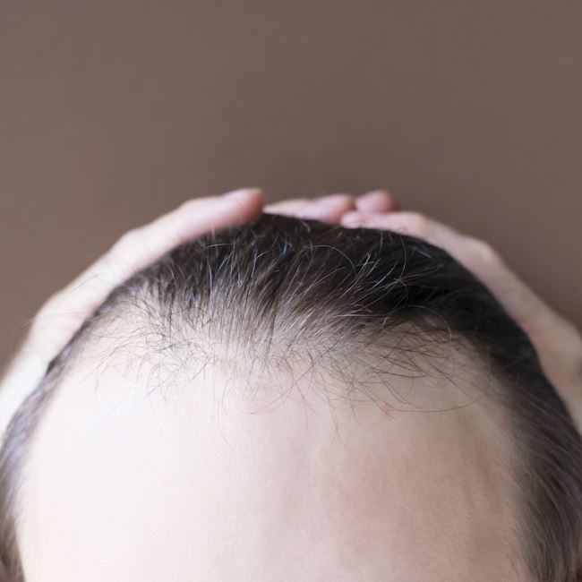 Saç Dökülmesi Neden Olur? Bilimsel Nedenler ve Etkili Çözümler